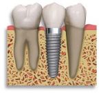 dental implant imagery... tooth screwed professionally into jaw bone