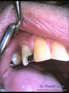 a fractured tooth being shown by the dentist