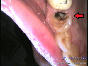 am image of a single decaying tooth