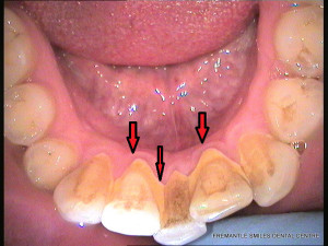 calculus build up behind the front teeth of a patient