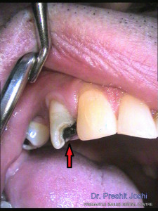 a decaying tooth being shown by the dentist