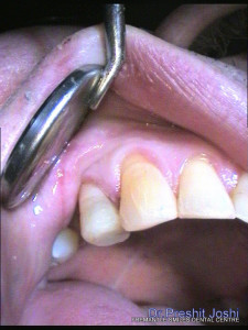 tooth that used to have a fracture professionally filled and intact