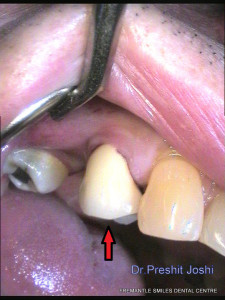 tooth filling mid procedure